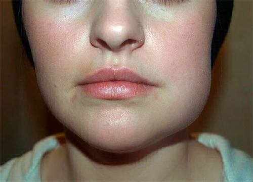основные причины опухания верхней губы