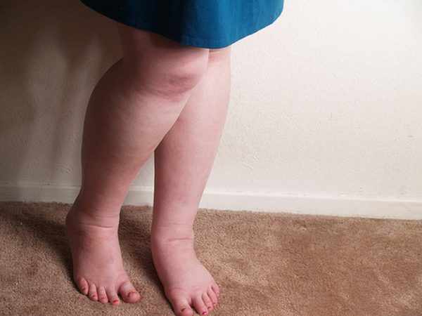 Отёки ног при беременности