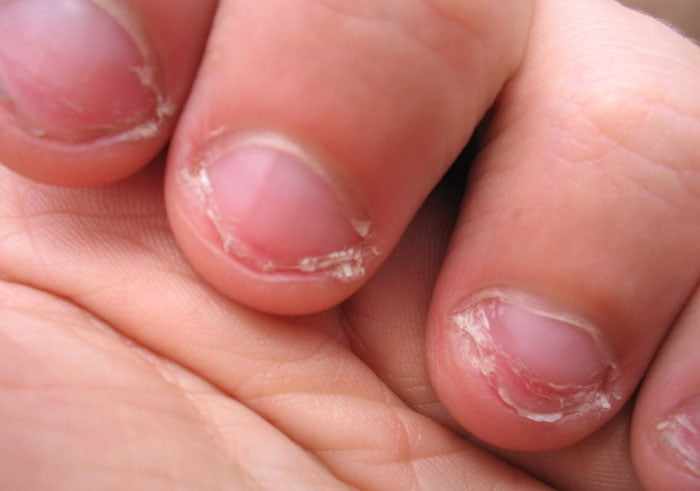 Обгрызенные ногти у ребенка