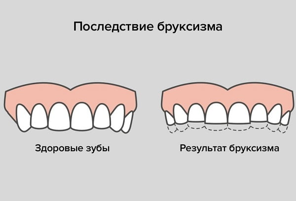 Бруксизм